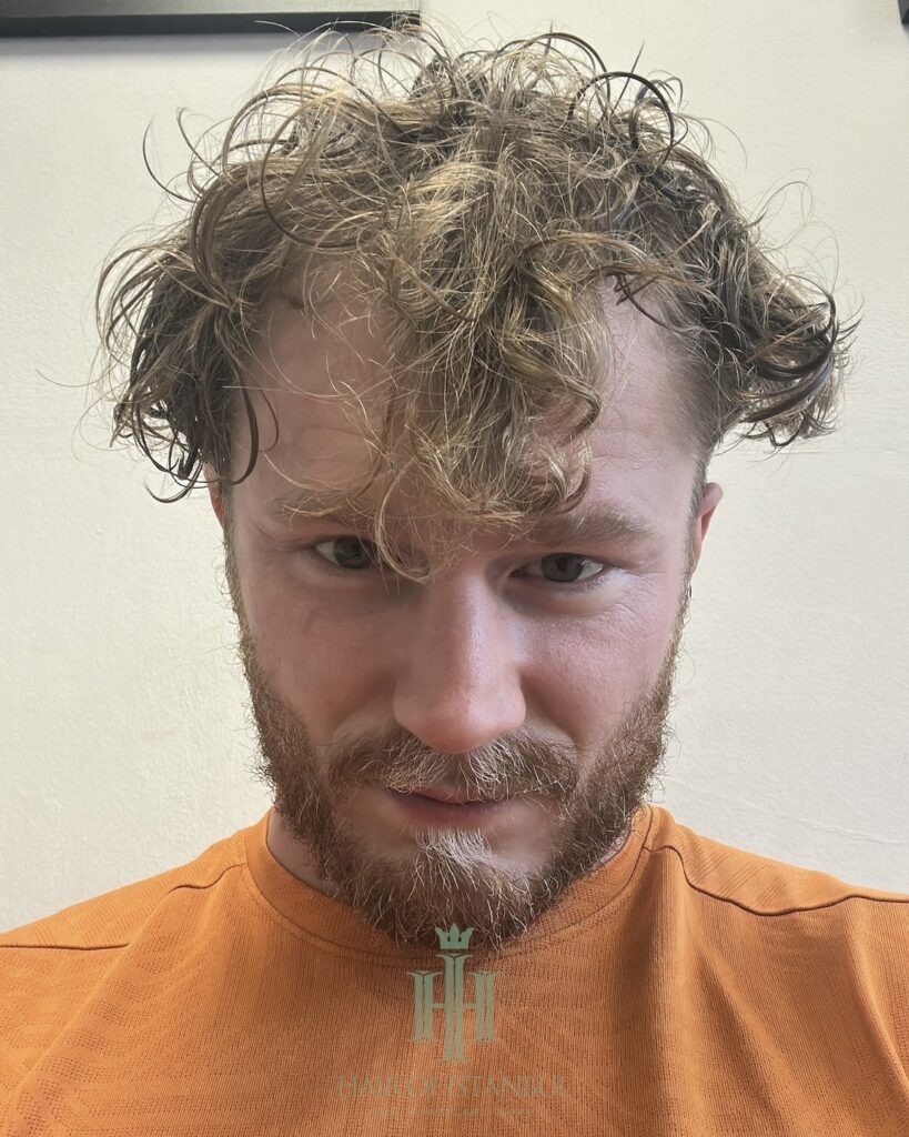 Saç ekimi sonucu, 2.700 greft, Öncesi (3) — Hair of Istanbul