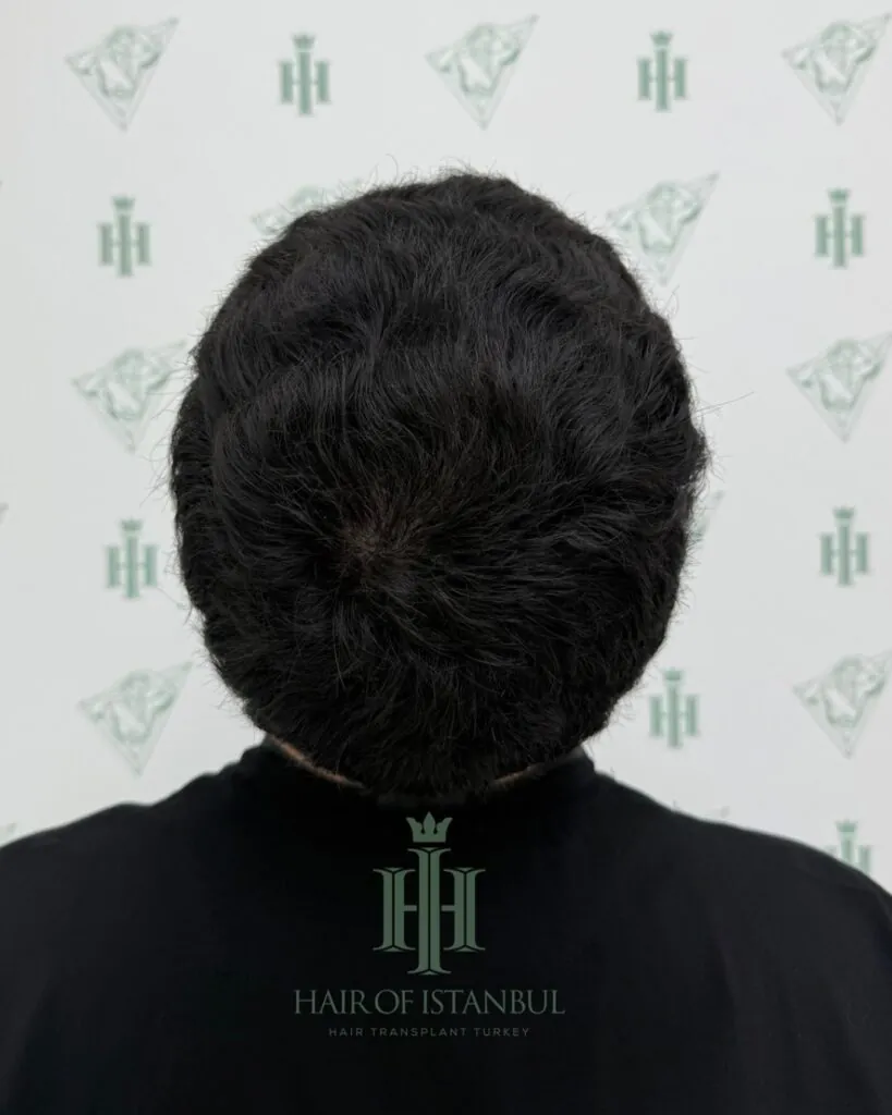 Saç ekimi sonucu, 5.800 greft, Donör alanı — Hair of Istanbul