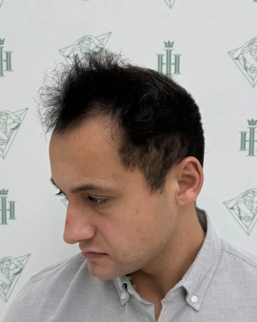 Saç ekimi sonucu, 4.400 greft, Öncesi (2) — Hair of Istanbul