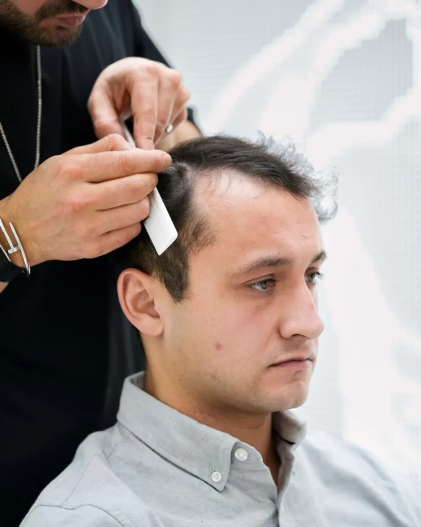 Saç ekimi sonucu, 4.400 greft, Saç çizgisi tasarımı — Hair of Istanbul