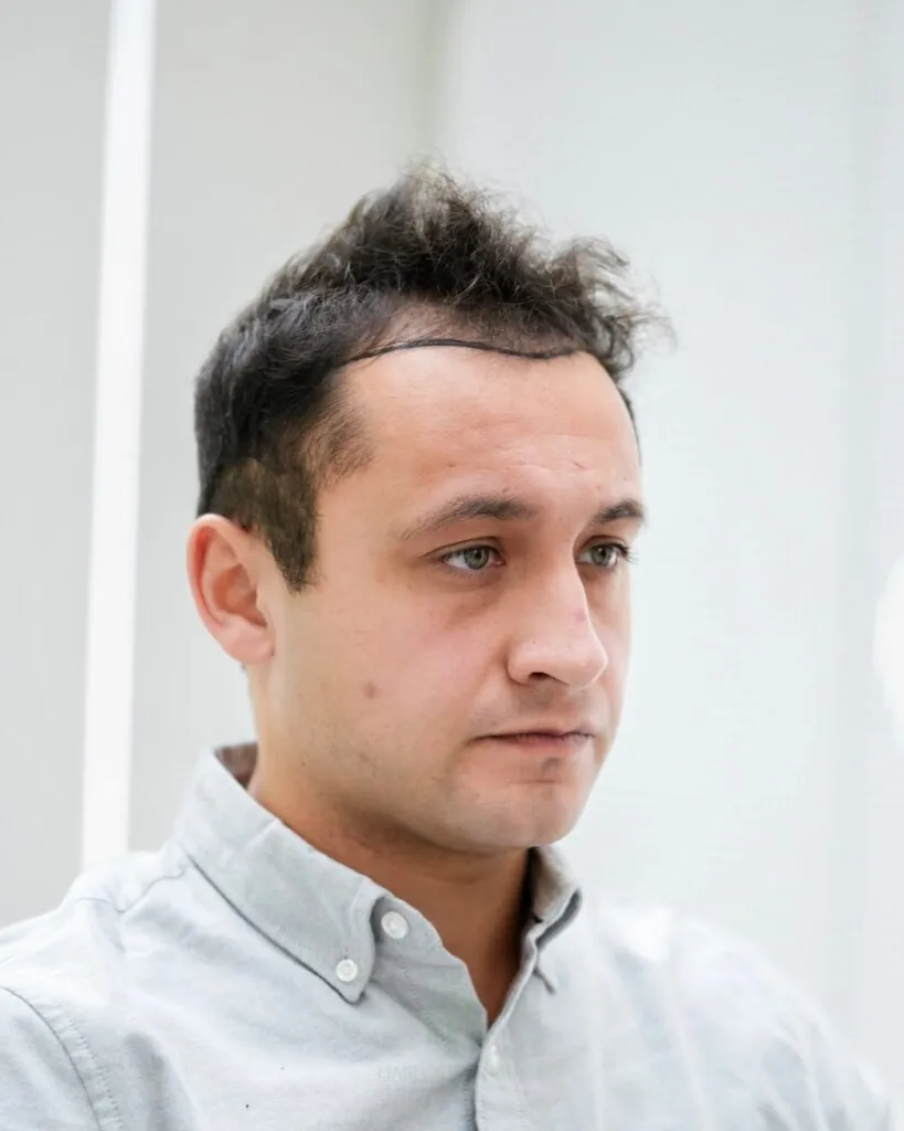 Saç ekimi sonucu, 4.400 greft, Saç çizgisi tasarımı (2) — Hair of Istanbul