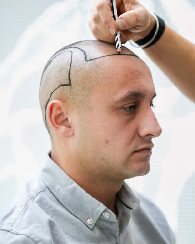 Saç ekimi sonucu, 4.400 greft, Saç çizgisi tasarımı (3) — Hair of Istanbul