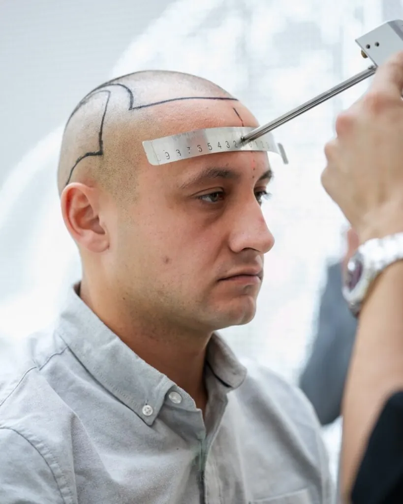Saç ekimi sonucu, 4.400 greft, Saç çizgisi tasarımı (4) — Hair of Istanbul