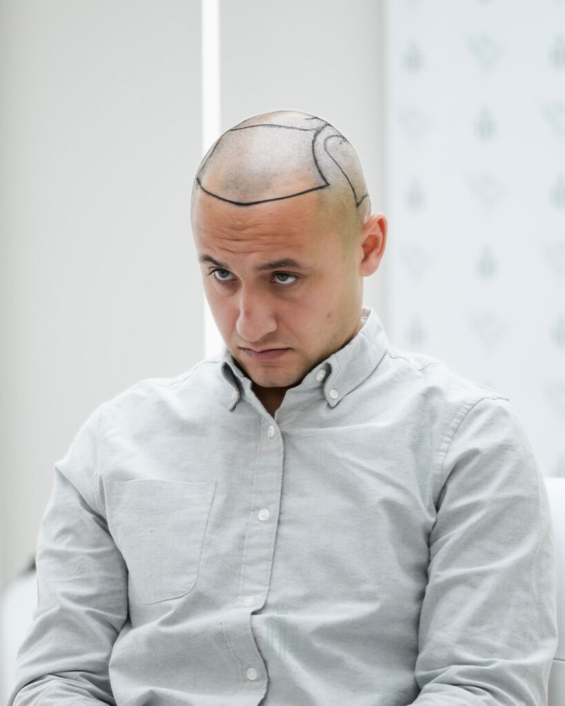Saç ekimi sonucu, 4.400 greft, Saç çizgisi tasarımı (5) — Hair of Istanbul