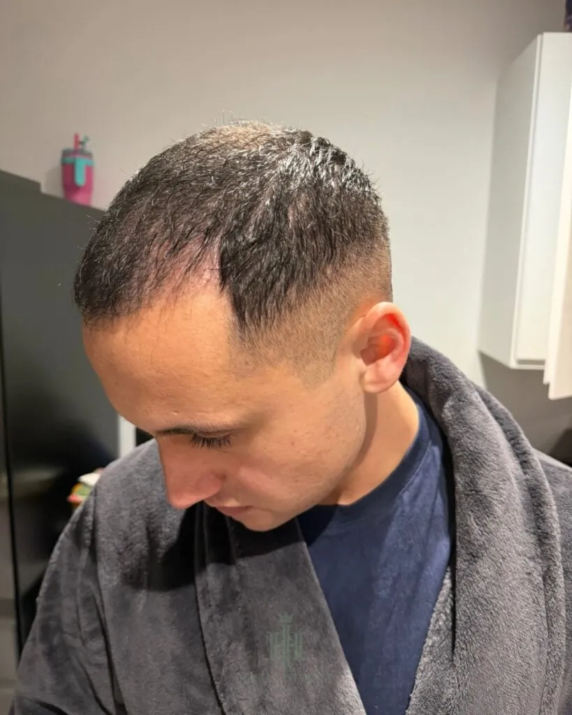 Saç ekimi sonucu, 4.400 greft, 1. ay — Hair of Istanbul