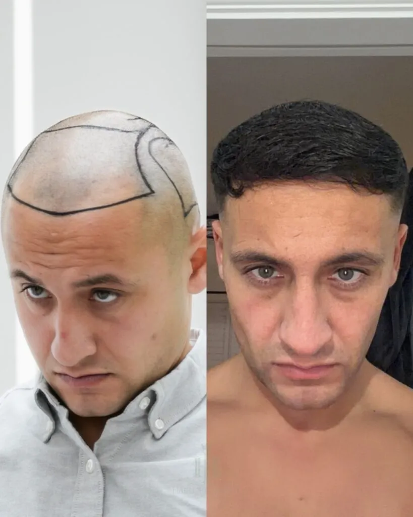 Saç ekimi sonucu, 4.400 greft, Öncesi & Sonrası — Hair of Istanbul