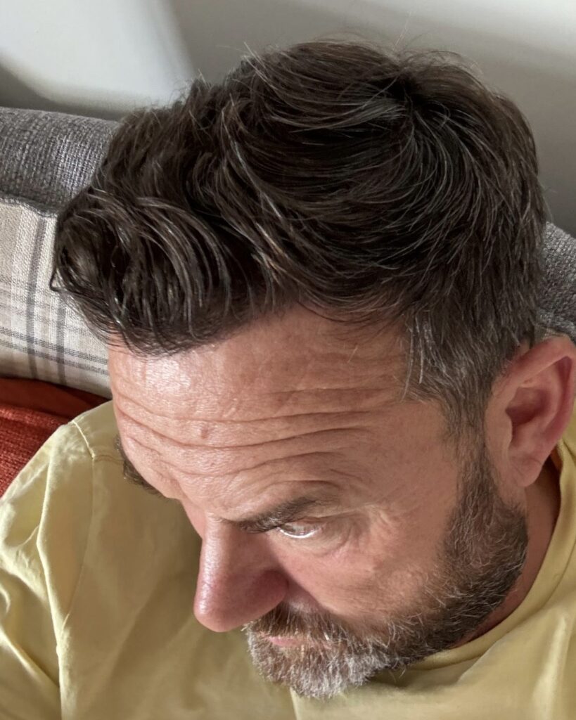 Saç ekimi sonucu, 2.100 greft, 6. yıl (4) — Hair of Istanbul