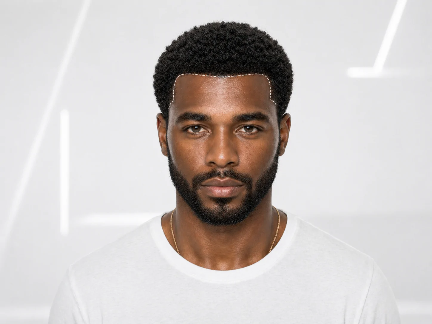 Afro Hair Transplant