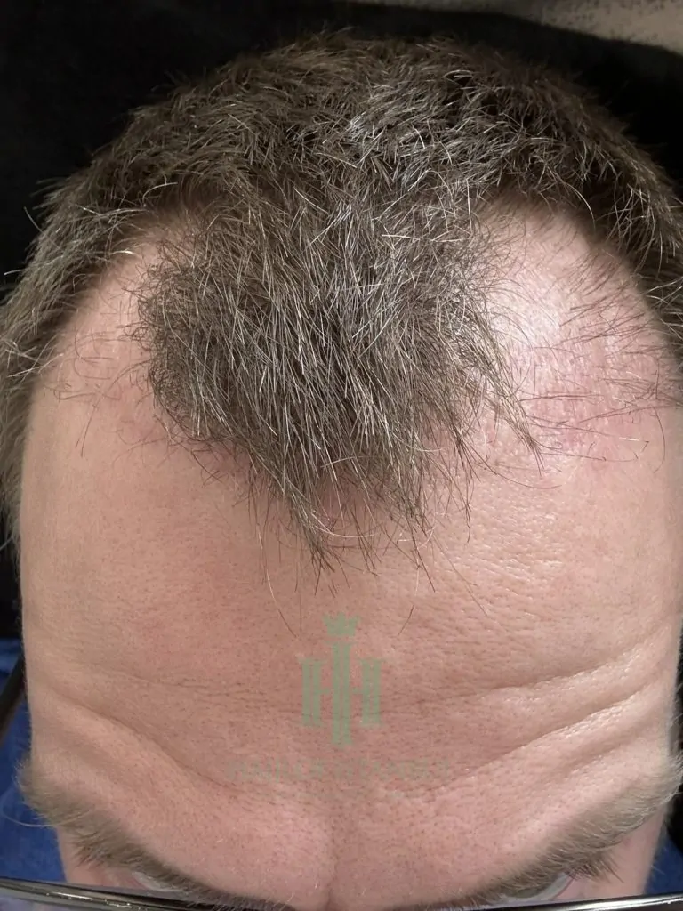 Before & After 270 Hair transplant result, 2,700 grafts, Month 1 — Hair of Istanbul
