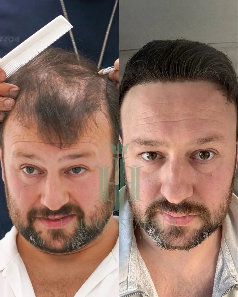 Before & After 295 Hair transplant result, 4,300 grafts, Before & After — Hair of Istanbul