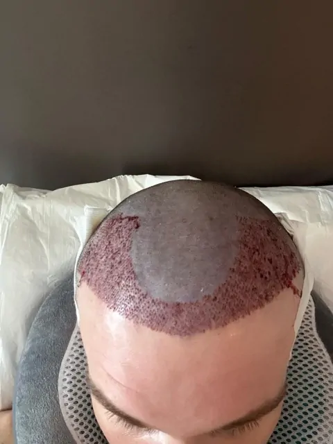 Before & After 241 Hair transplant result, 2,500 grafts, Day 1 — Hair of Istanbul