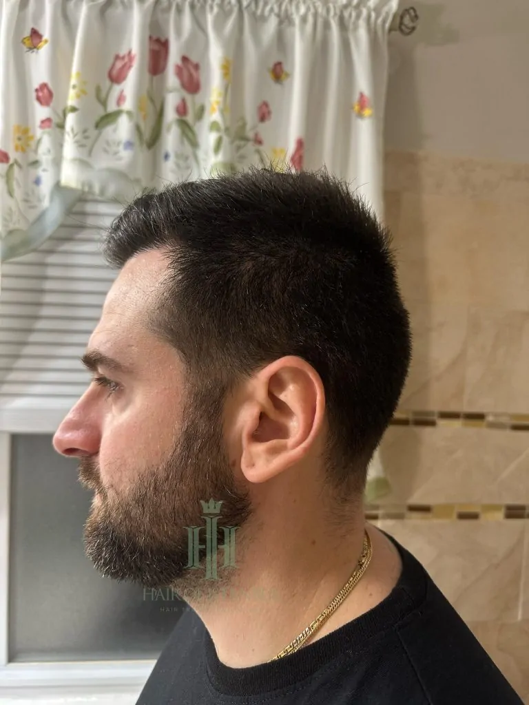 Before & After 189 Hair transplant result, 4,450 grafts, Month 7 — Hair of Istanbul