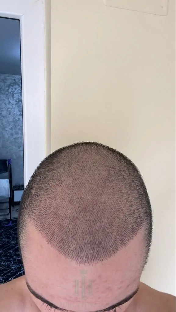 Before & After 258 Hair transplant result, 3,100 grafts, Day 10 — Hair of Istanbul