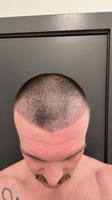 Before & After 243 Hair transplant result, 2,500 grafts, Day 10 (2) — Hair of Istanbul