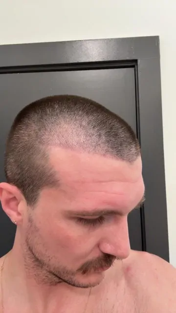 Before & After 242 Hair transplant result, 2,500 grafts, Day 10 — Hair of Istanbul