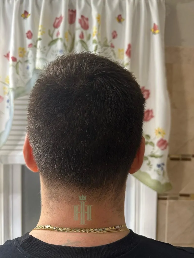 Before & After 191 Hair transplant result, 4,450 grafts, Donor area — Hair of Istanbul
