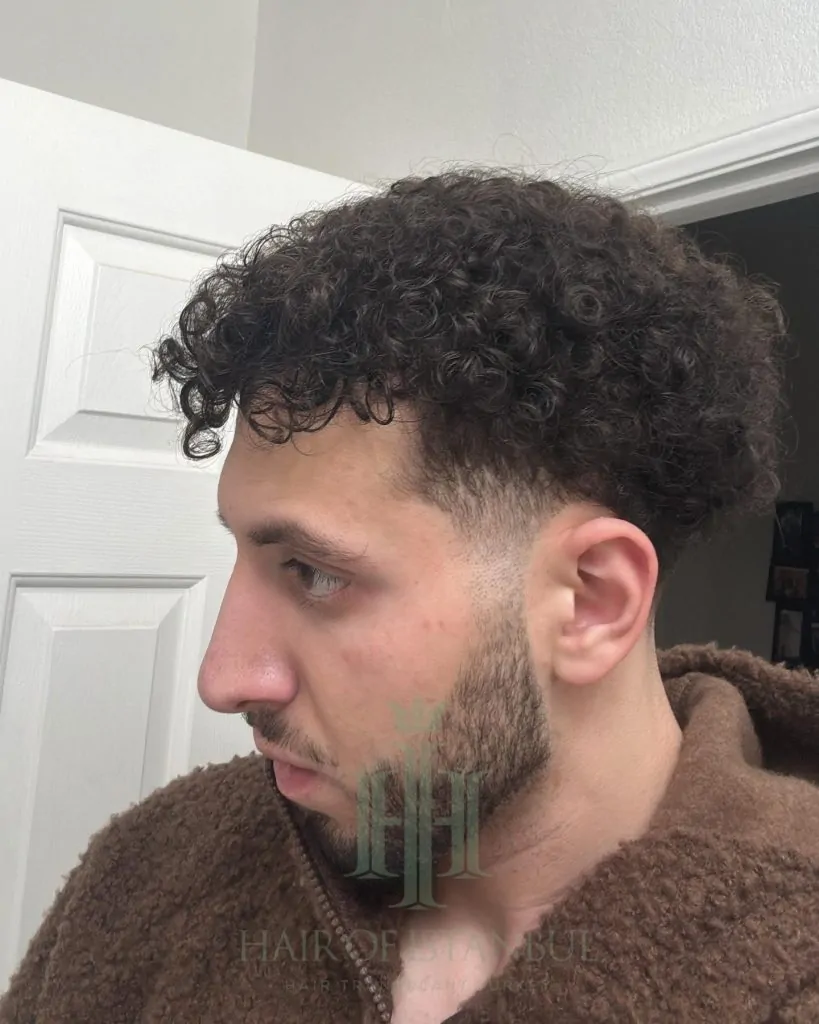 Before & After 208 Hair transplant result, 4,500 grafts, Month 12 — Hair of Istanbul