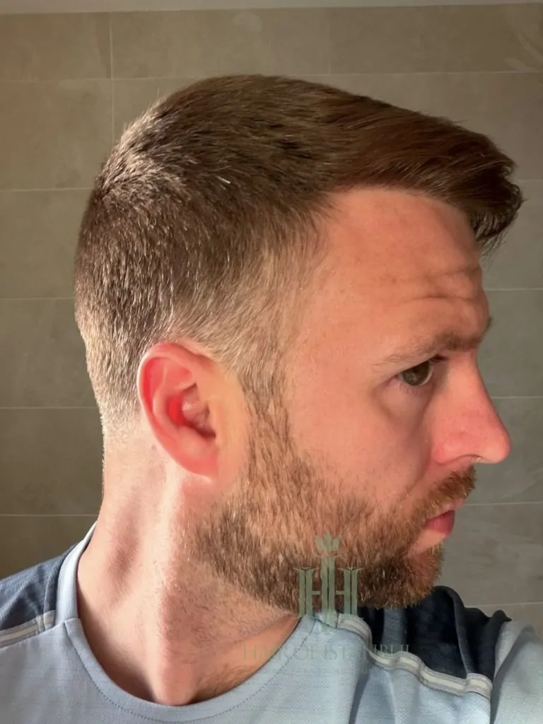 Before & After 275 Hair transplant result, 2,700 grafts, Month 12 (2) — Hair of Istanbul
