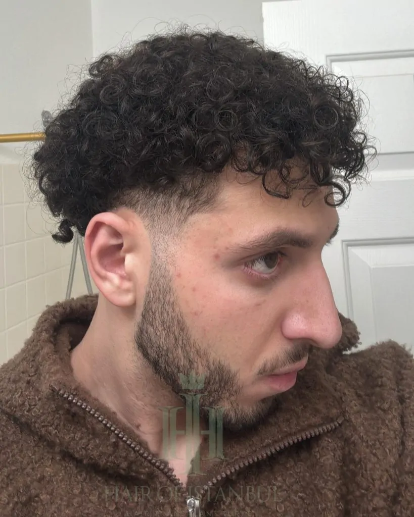 Before & After 209 Hair transplant result, 4,500 grafts, Month 12 (2) — Hair of Istanbul