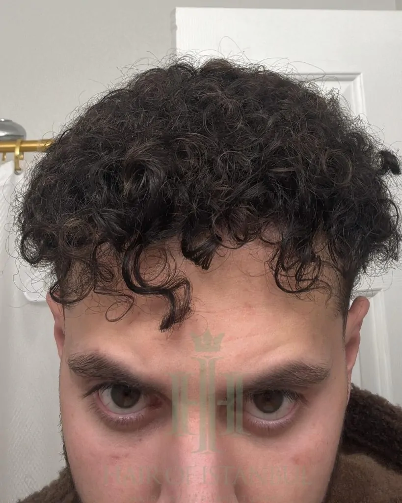 Before & After 210 Hair transplant result, 4,500 grafts, Month 12 (3) — Hair of Istanbul
