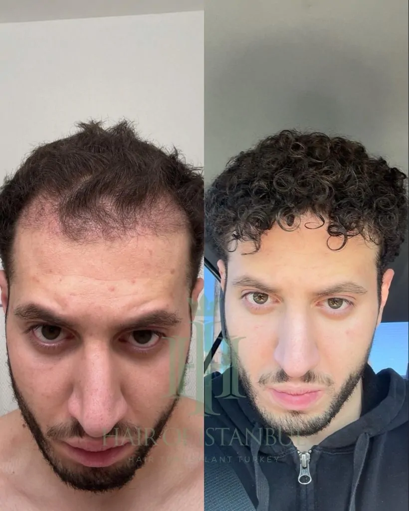 Before & After 213 Hair transplant result, 4,500 grafts, Before & After (2) — Hair of Istanbul