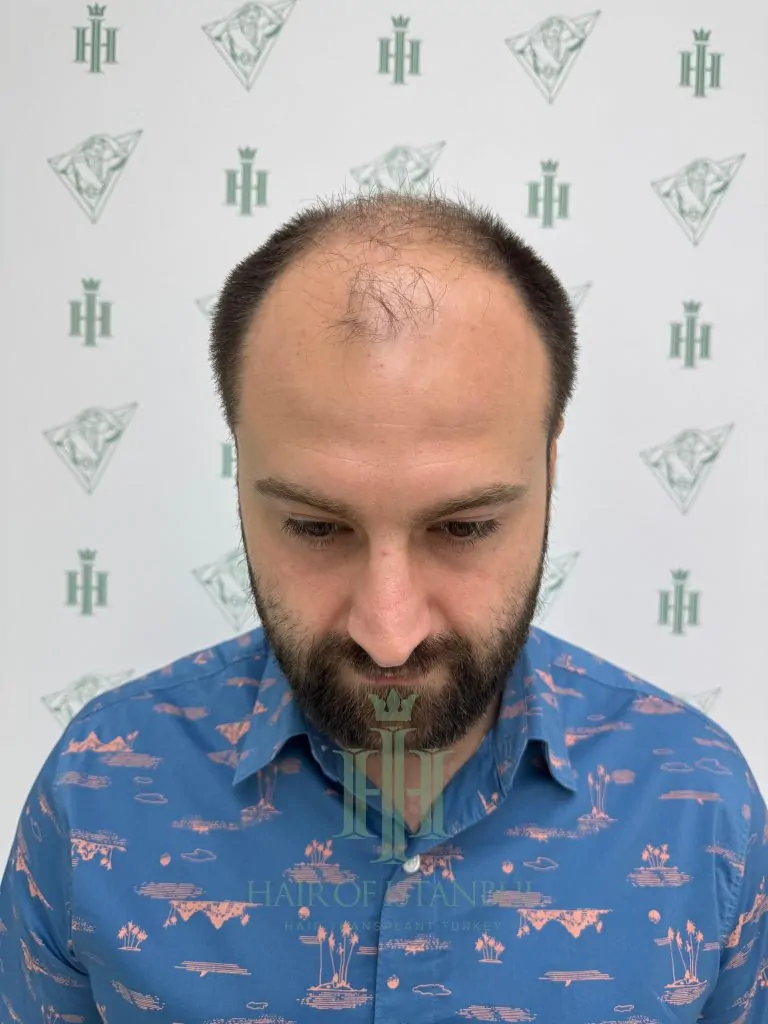 Before & After 181 Hair transplant result, 4,450 grafts, Before — Hair of Istanbul