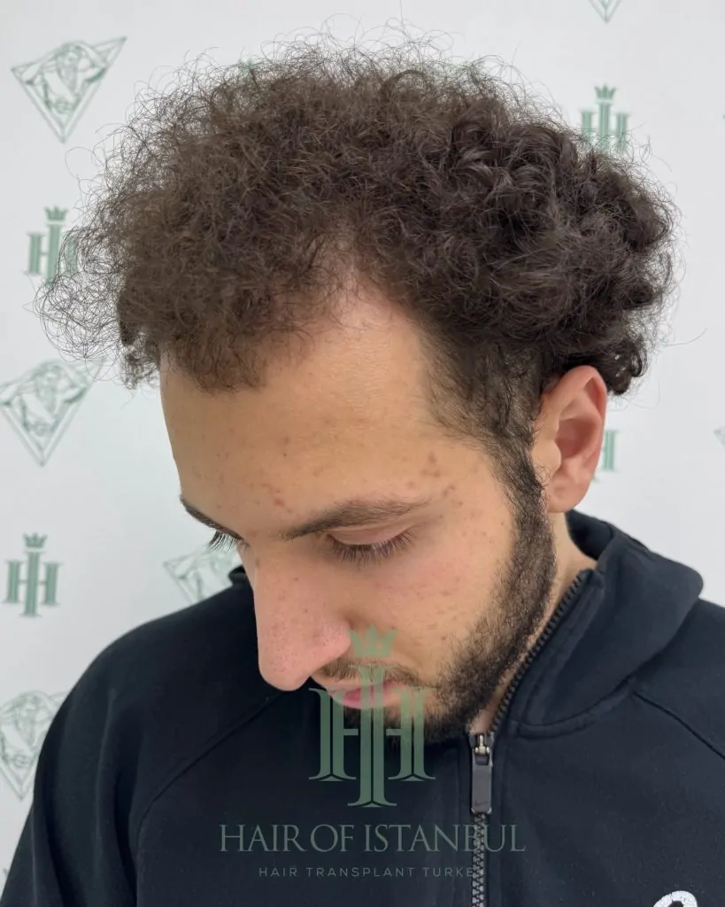Before & After 199 Hair transplant result, 4,500 grafts, Before (2) — Hair of Istanbul