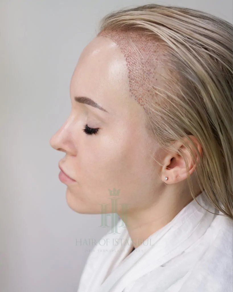 Before & After 316 Women’s hair transplant result, 2,000 grafts, Day 3 — Hair of Istanbul
