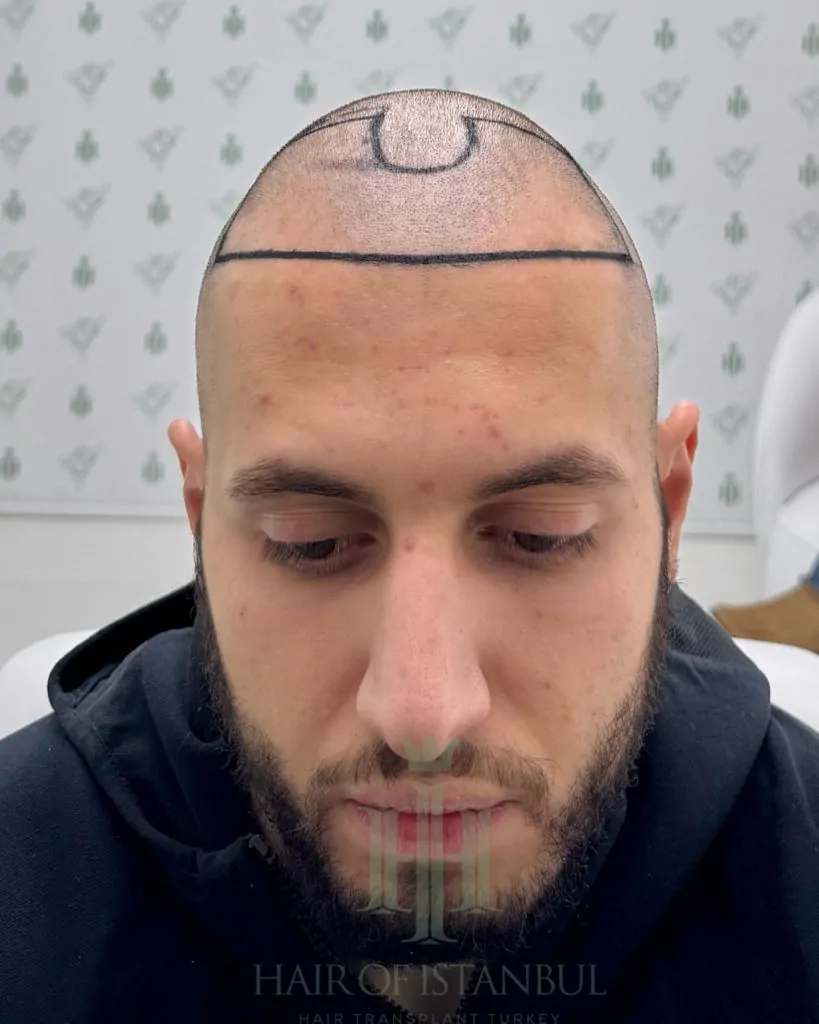 Before & After 201 Hair transplant result, 4,500 grafts, Hairline design — Hair of Istanbul