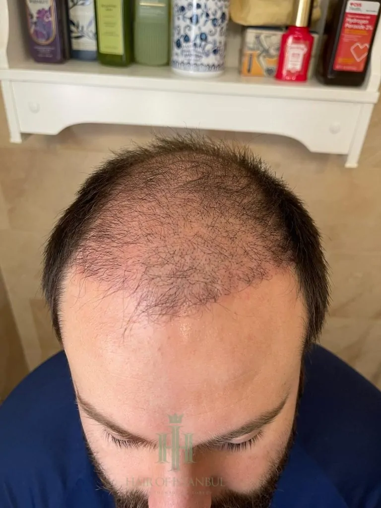 Before & After 187 Hair transplant result, 4,450 grafts, Month 1 — Hair of Istanbul