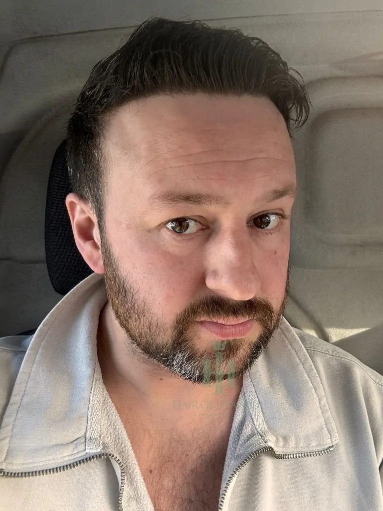 Before & After 306 Hair transplant result, 4,300 grafts, Month 11 (2) — Hair of Istanbul
