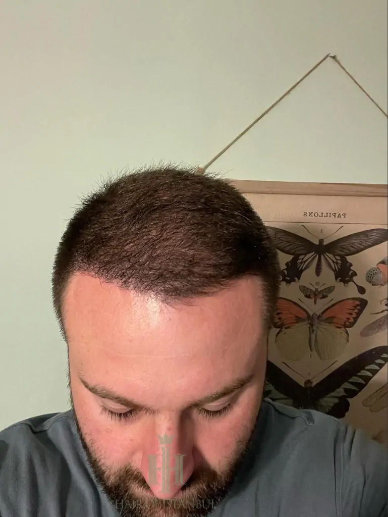 Before & After 188 Hair transplant result, 4,450 grafts, Month 4 — Hair of Istanbul