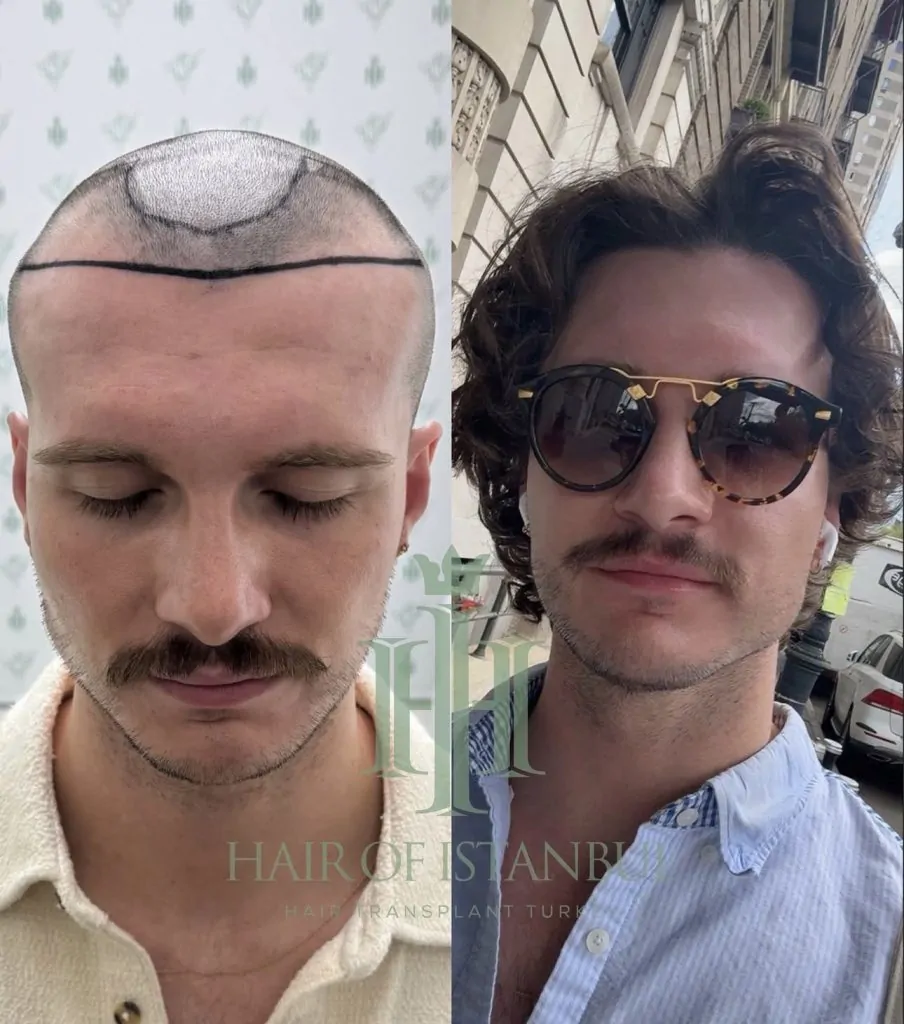 Before & After 249 Hair transplant result, 2,500 grafts, Before & After (3) — Hair of Istanbul
