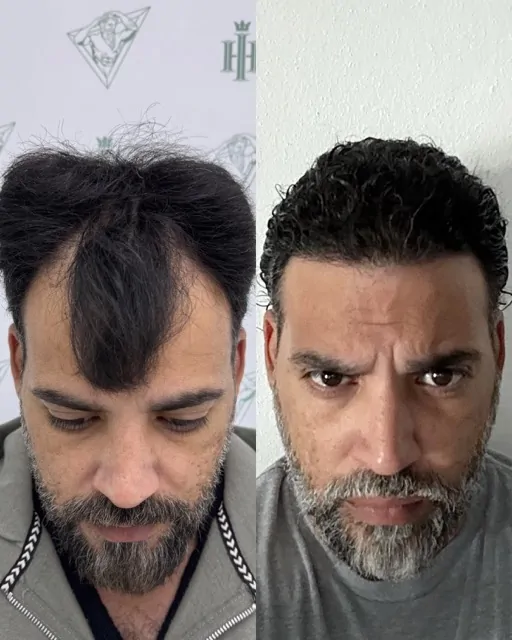 Before & After 214 Hair transplant result, 4,200 grafts, Before & After — Hair of Istanbul