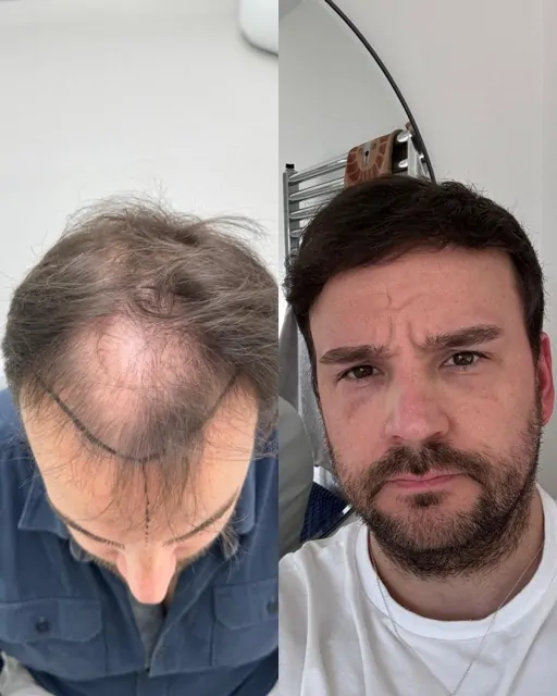 Before & After 226 Hair transplant result, 4,100 grafts, Before & After — Hair of Istanbul