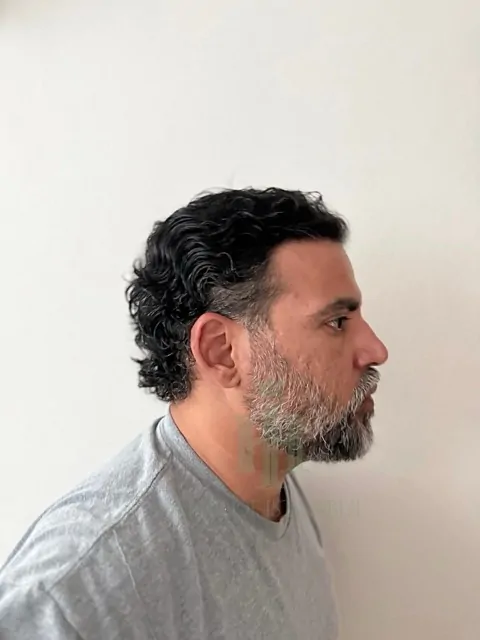 Before & After 222 Hair transplant result, 4,200 grafts, Month 11 — Hair of Istanbul
