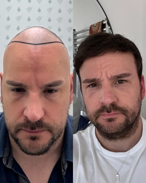 Before & After 235 Hair transplant result, 4,100 grafts, Month 12 (3) — Hair of Istanbul