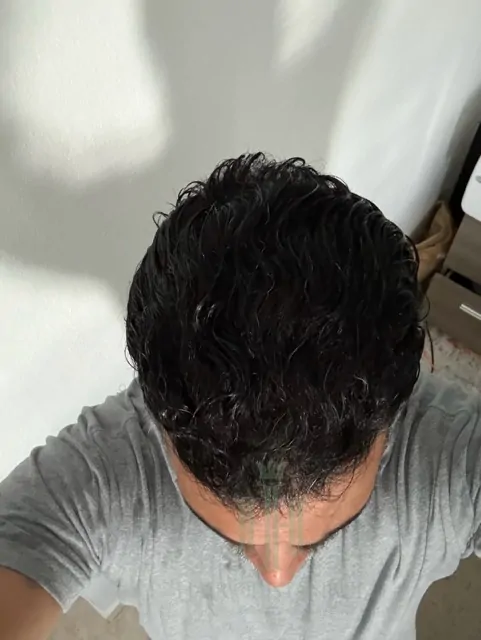 Before & After 223 Hair transplant result, 4,200 grafts, Month 11 (2) — Hair of Istanbul