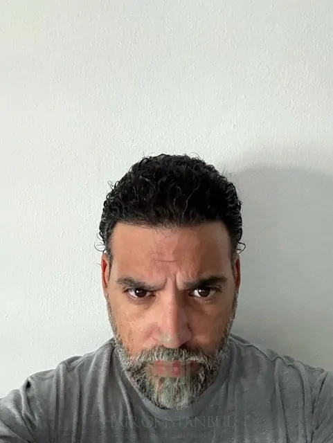Before & After 224 Hair transplant result, 4,200 grafts, Month 11 (3) — Hair of Istanbul