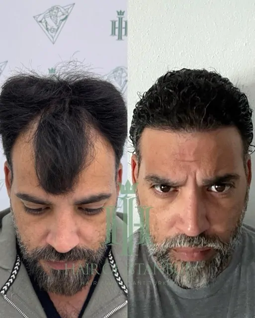 Before & After 225 Hair transplant result, 4,200 grafts, Before & After (2) — Hair of Istanbul