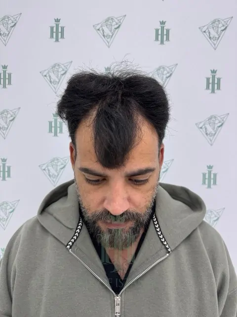 Before & After 215 Hair transplant result, 4,200 grafts, Before — Hair of Istanbul