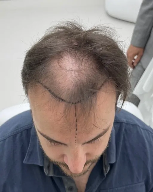 Before & After 227 Hair transplant result, 4,100 grafts, Before — Hair of Istanbul