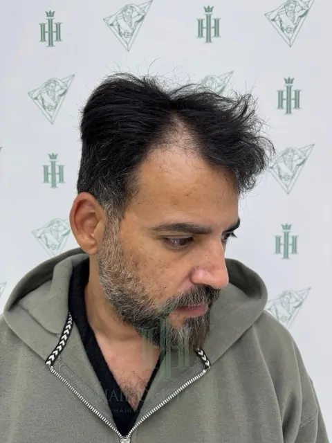 Before & After 216 Hair transplant result, 4,200 grafts, Before (2) — Hair of Istanbul