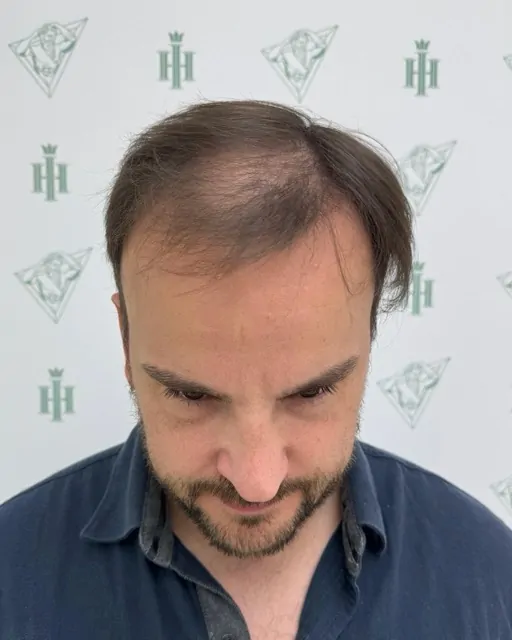 Before & After 228 Hair transplant result, 4,100 grafts, Before (2) — Hair of Istanbul