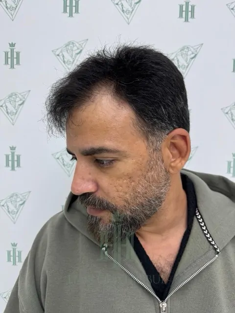 Before & After 217 Hair transplant result, 4,200 grafts, Before (3) — Hair of Istanbul