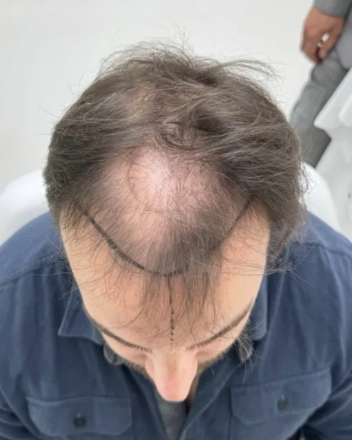 Before & After 229 Hair transplant result, 4,100 grafts, Before (3) — Hair of Istanbul