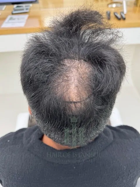 Before & After 218 Hair transplant result, 4,200 grafts, Before (4) — Hair of Istanbul
