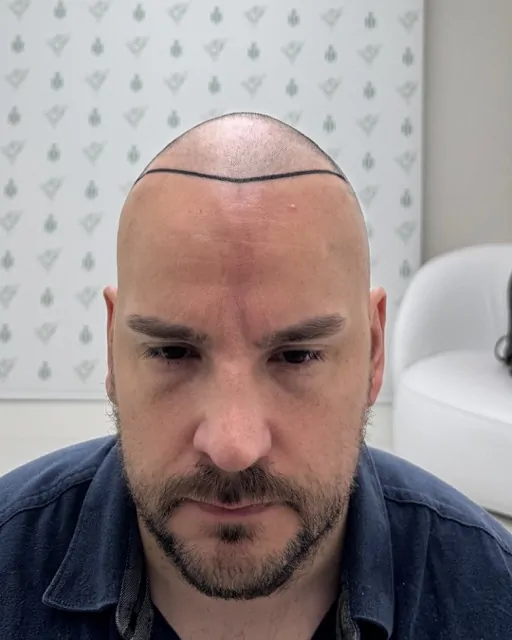 Before & After 230 Hair transplant result, 4,100 grafts, Hairline design — Hair of Istanbul