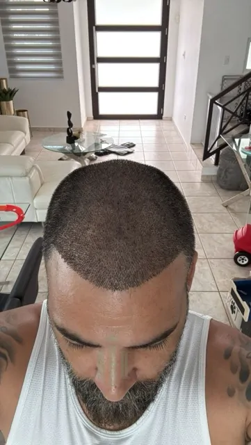 Before & After 220 Hair transplant result, 4,200 grafts, Day 3 — Hair of Istanbul