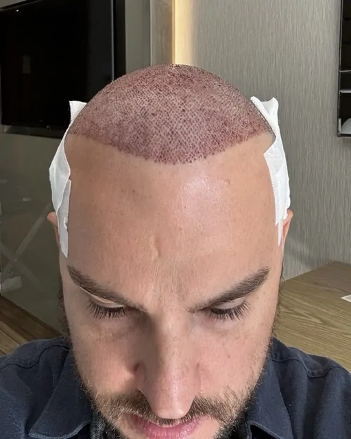 Before & After 231 Hair transplant result, 4,100 grafts, Day 1 — Hair of Istanbul